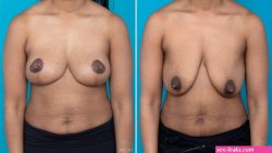 What Causes Sagging Breasts -Causes Surgery for Breast Ptosis
