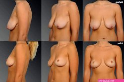Best Breast Lift Los Angeles