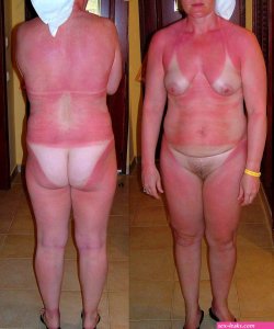 File:Naked heavily burnt female body..jpg