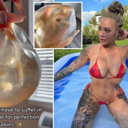 Woman reveals moldy breast implants after life-changing removal