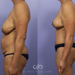 Mommy Makeover Before and After Pictures Case 729