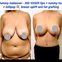 Mummy Makeover Surgery: 5 Questions to Ask Your Surgeon