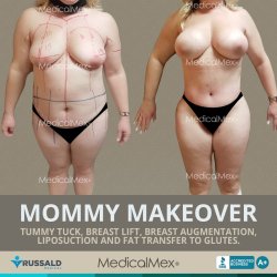 Mommy Makeover Surgery in Tijuana Mexico