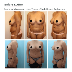 Mummy Makeover