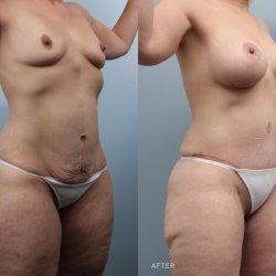 Is a Mommy Makeover Safe?
