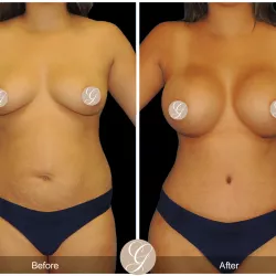 Mommy Makeover Newport Beach Orange County