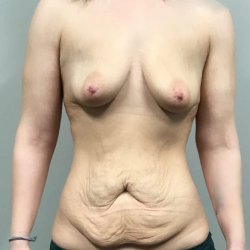 Mommy Makeover with Tummy Tuck and Breast Implants