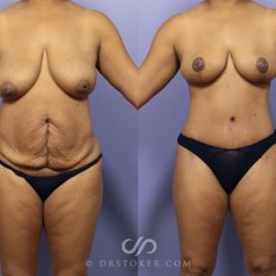 Mommy Makeover Before and After Pictures Case 729